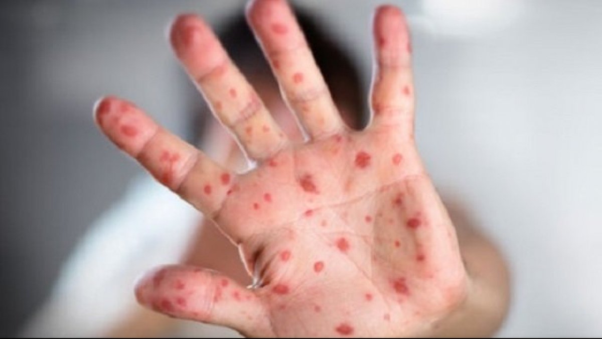 Епідемія триває: кількість захворювань респіраторними інфекціями на Закарпатті зростає