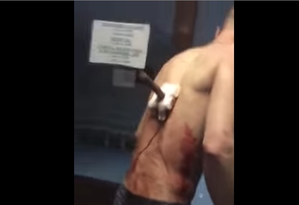 Перекур з ножем у спині: у лікарні чоловік який отримав поранення потрапив на відео (ВІДЕО)