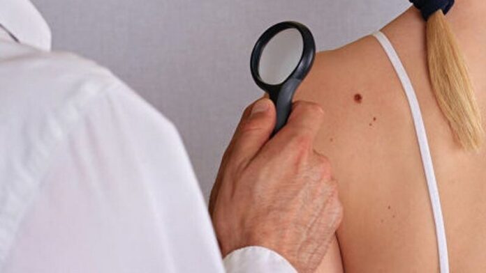 Перевір себе: лікарі назвали п'ять ознак, які можуть вказувати на розвиток раку шкіри