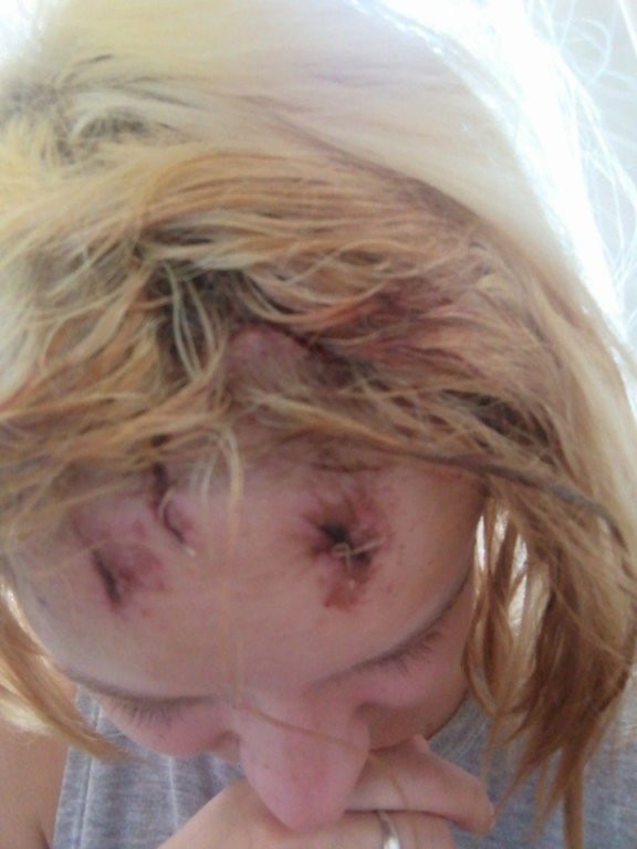 В Ужгороді роми розбили дівчині голову! (ФОТО)