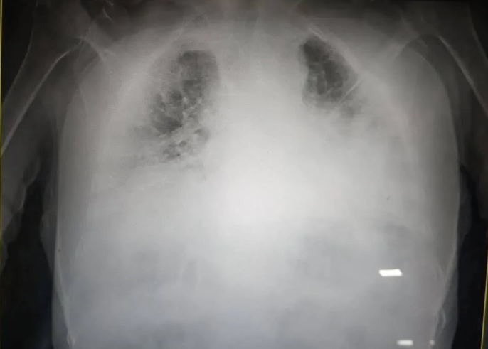 "Найстрашніші легені, які я коли-небудь бачила": лікар показала легені пацієнта з коронавірусом (ФОТО)