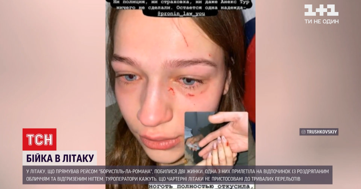 На рейсі до Домінікани сталася бійка між українськими пасажирами: дівчині відгризли ніготь