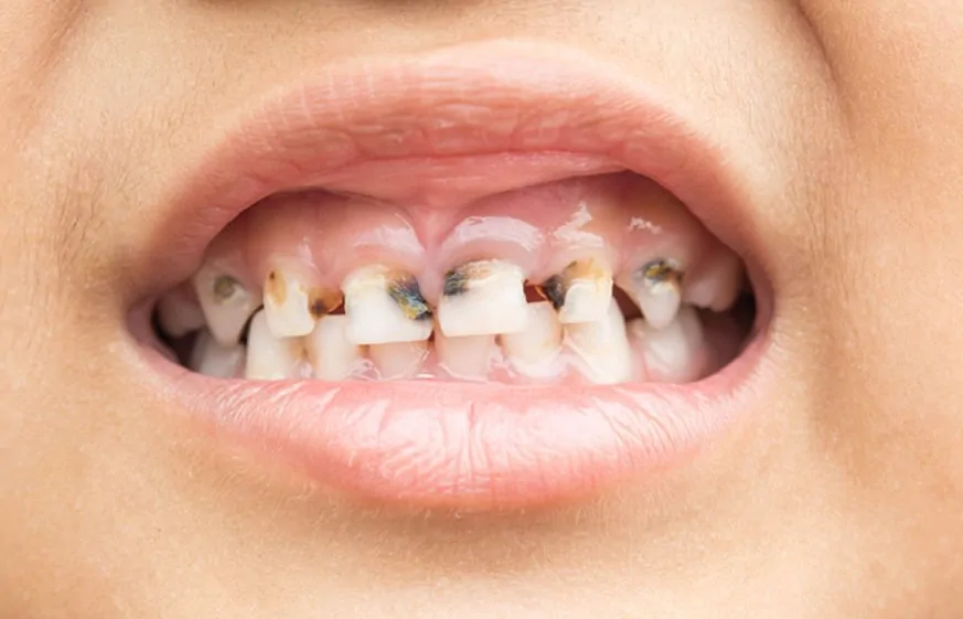 Найпоширеніші дитячі проблеми з зубами: причини захворювання та методи лікування
